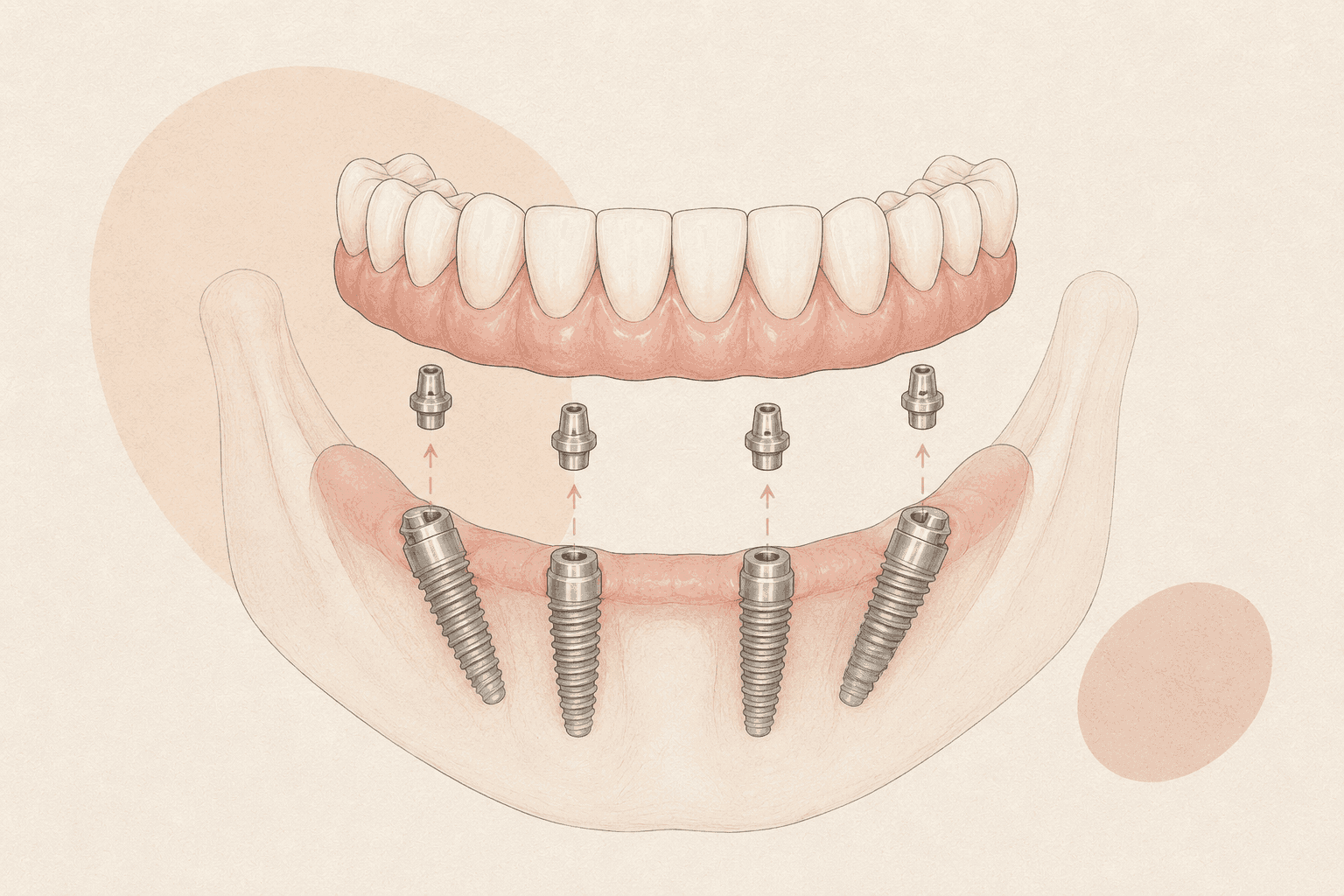 All-on-4 Full-Arch Rehabilitation