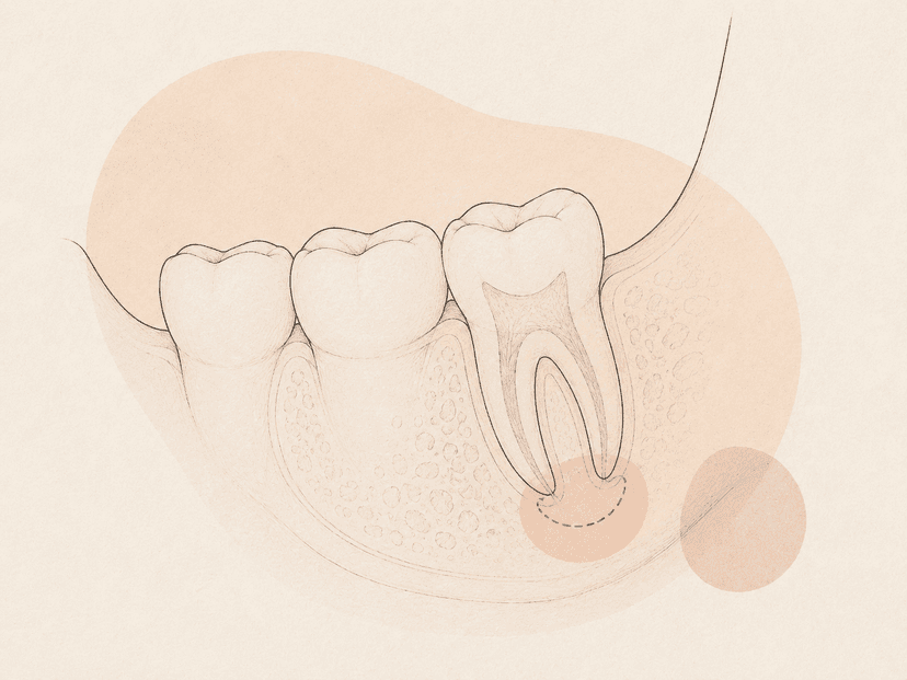 Apicoectomy