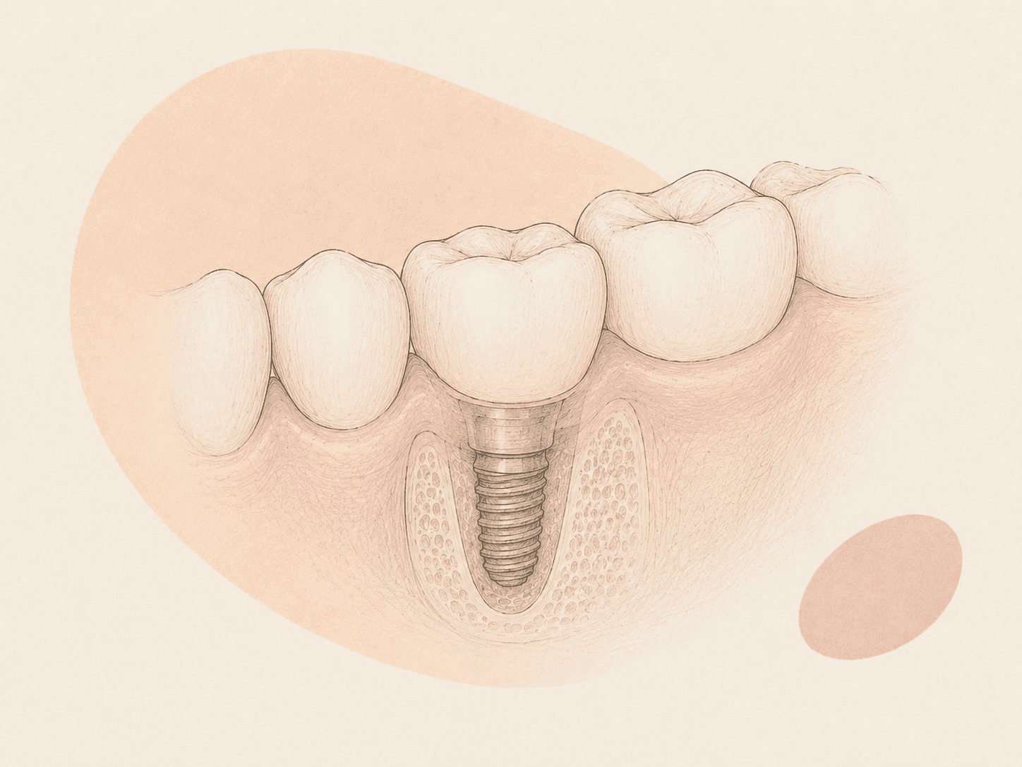 Single Dental Implant