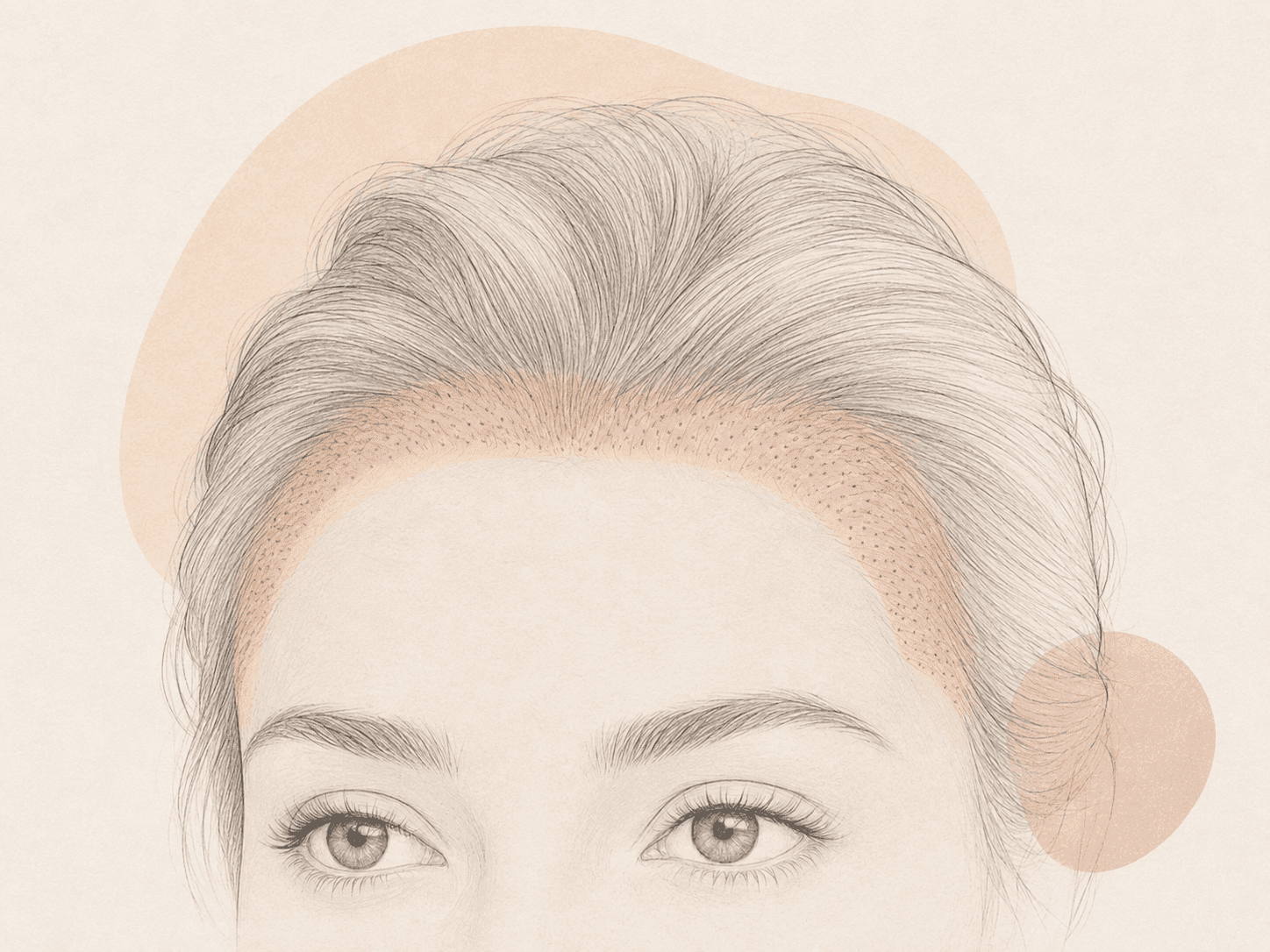 Female Hair Transplantation