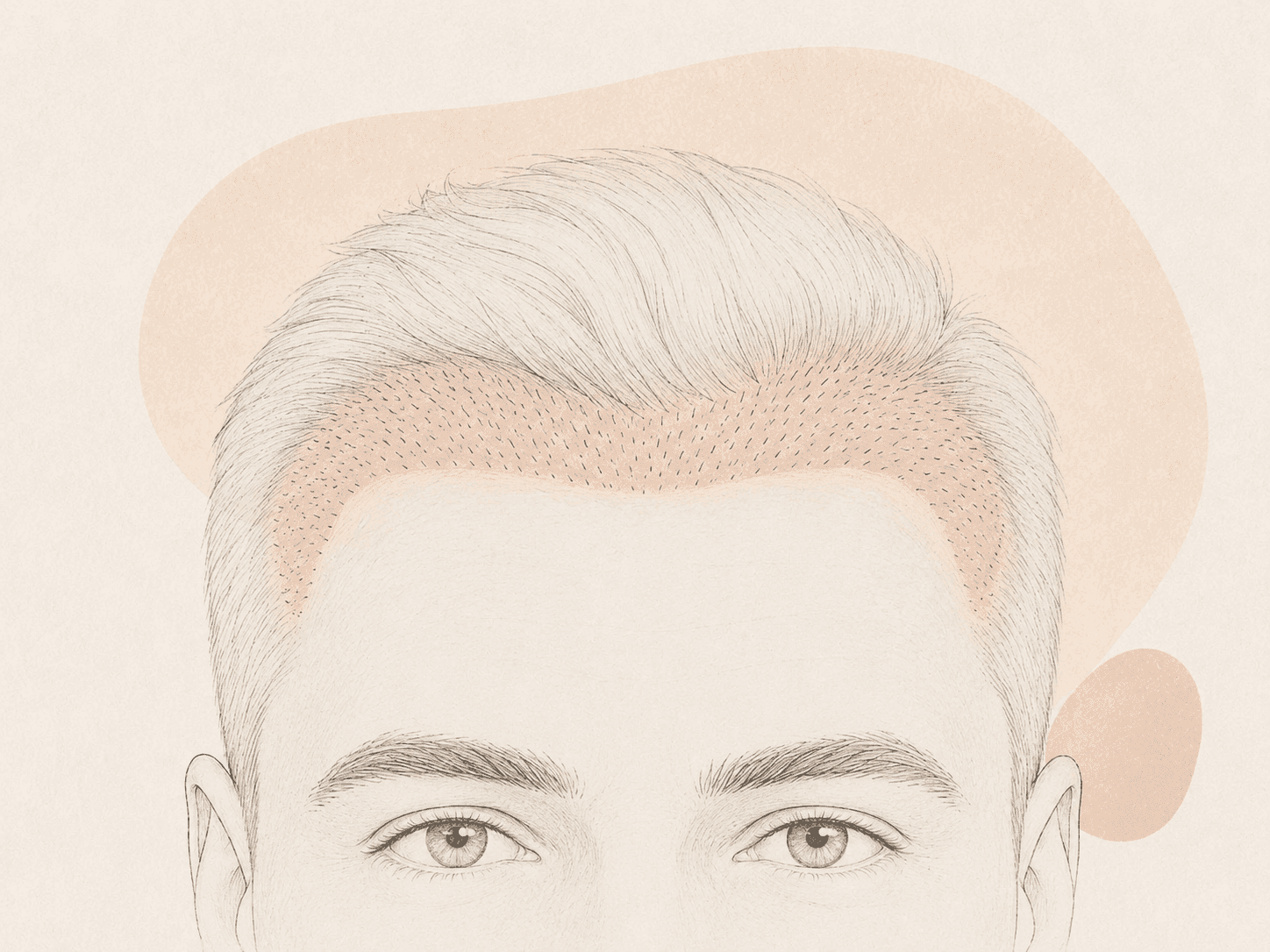 Follicular Unit Excision Hair Transplant