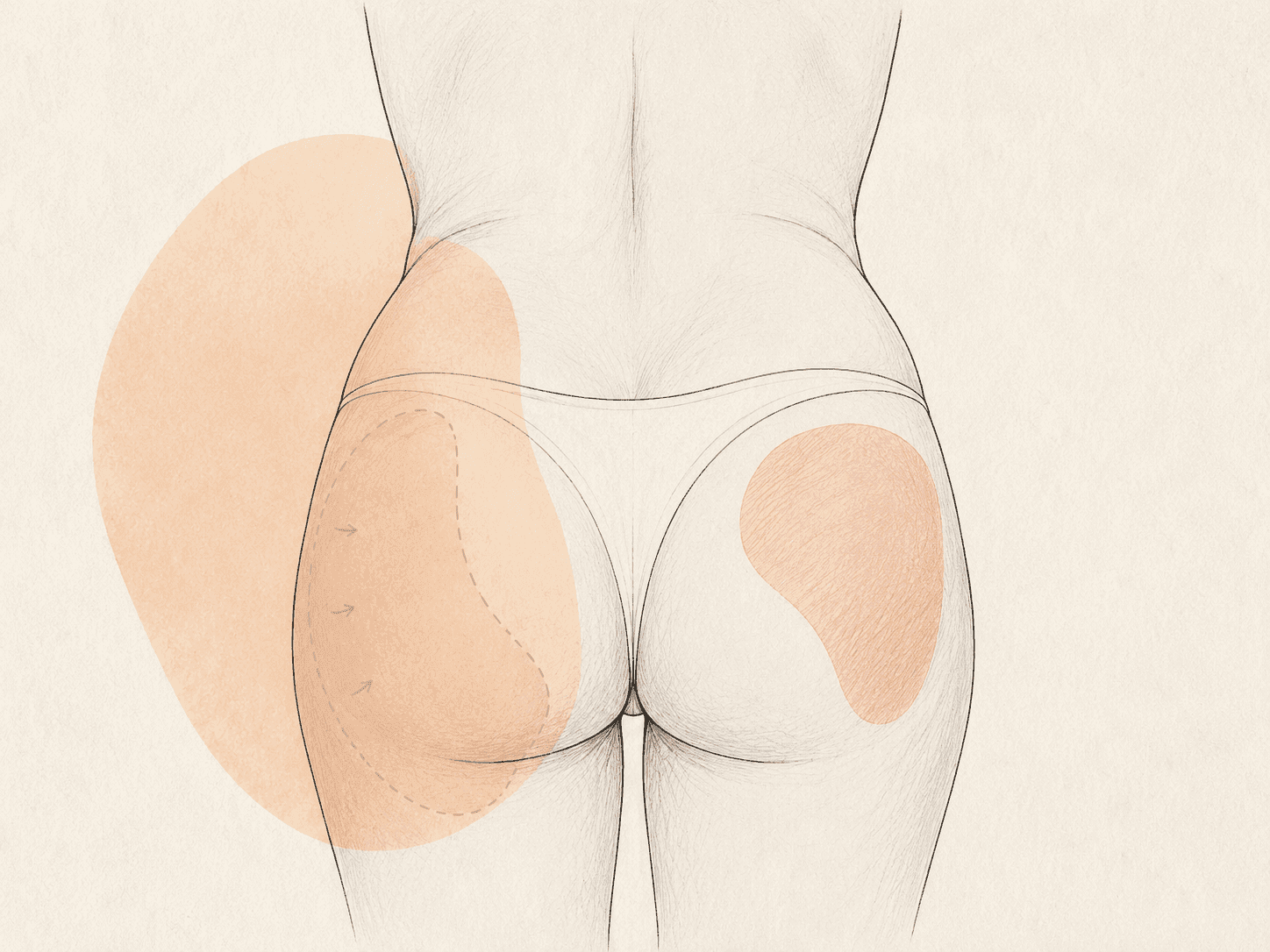 Gluteale Fetttransplantation