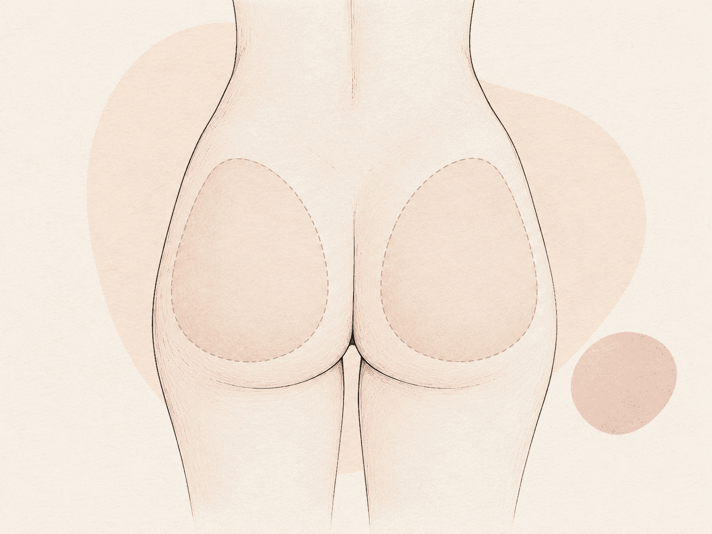 Gesäßimplantate