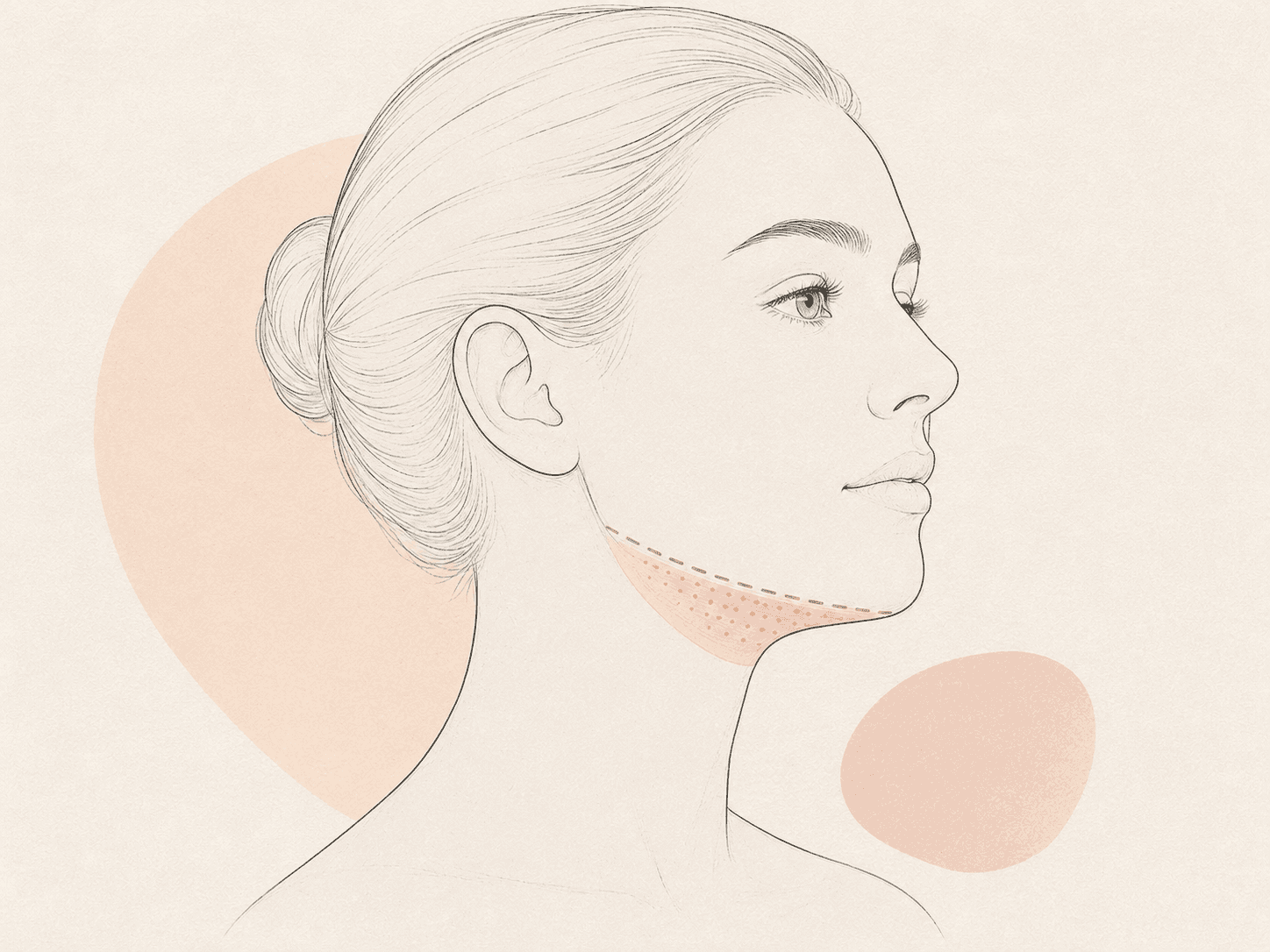 Submentale Liposuktion