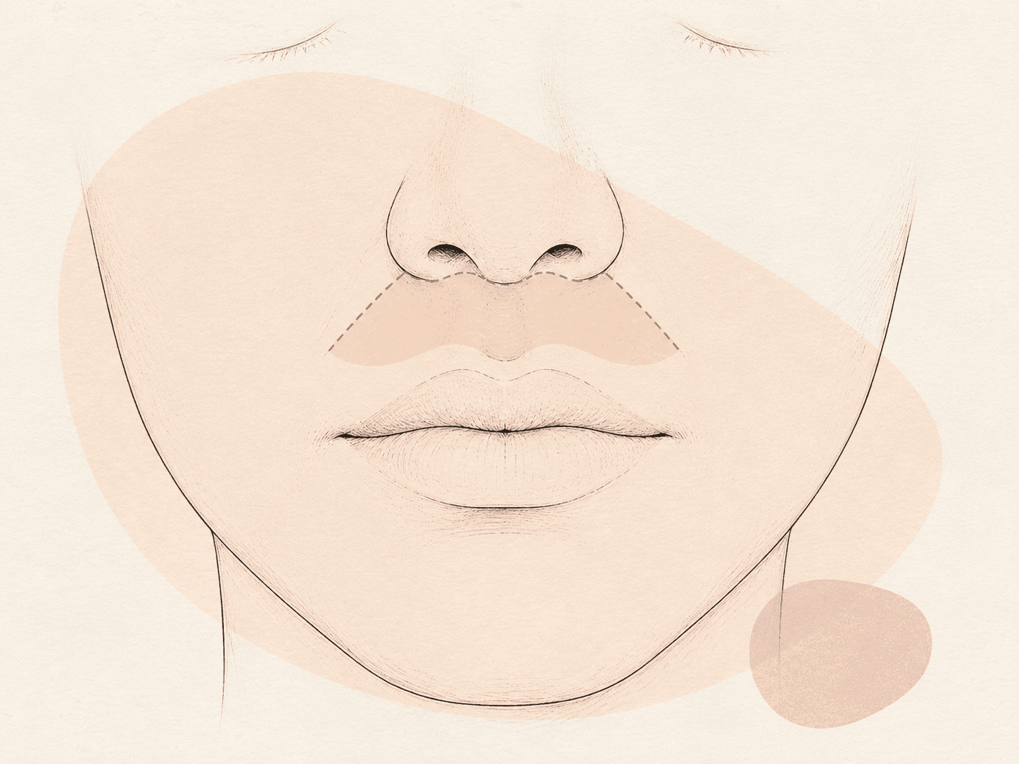 Lip Lift