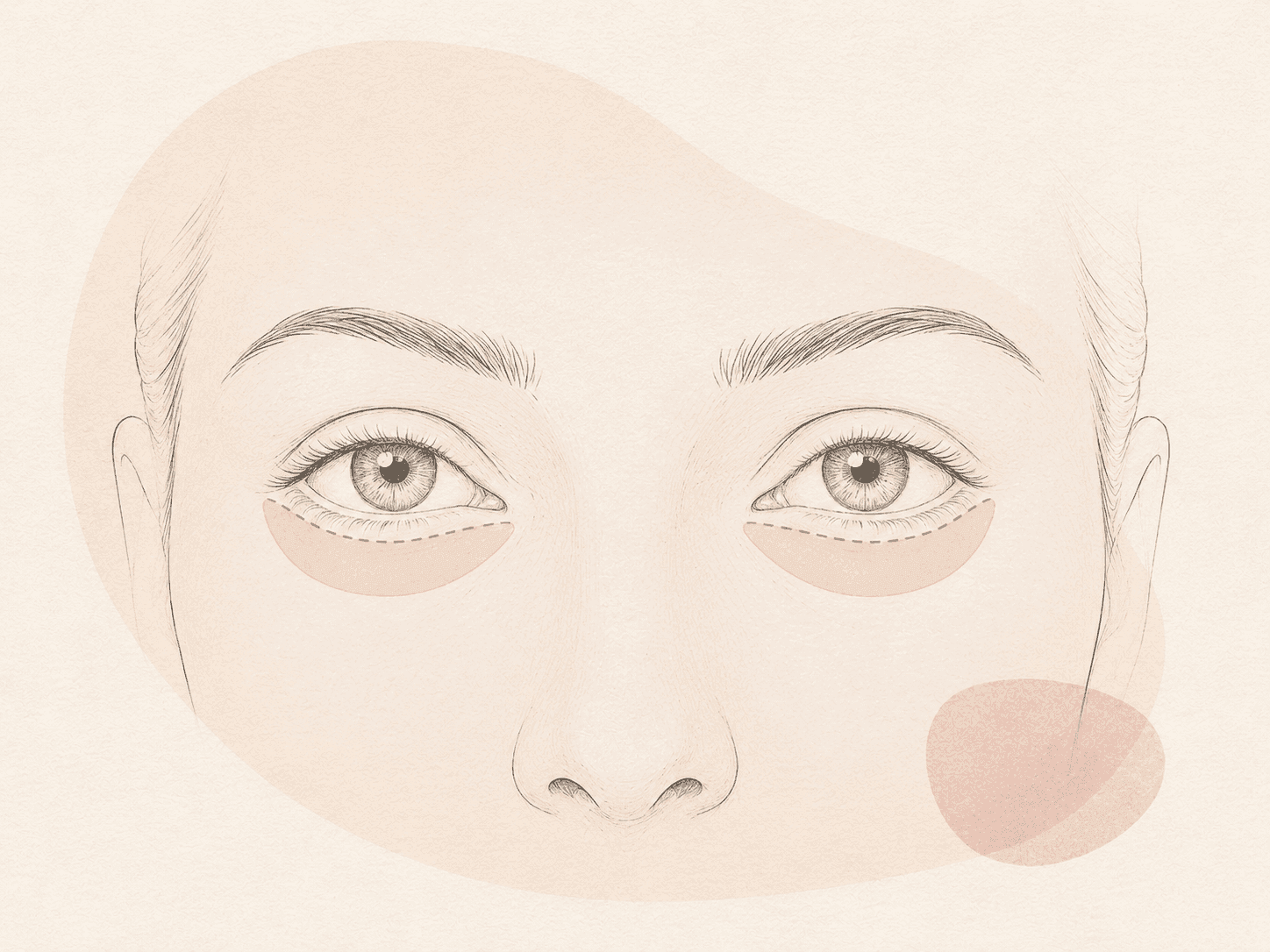 Unterlidblepharoplastik