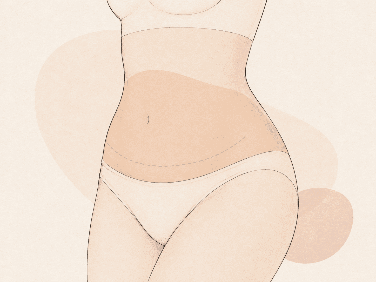 Abdominoplasty