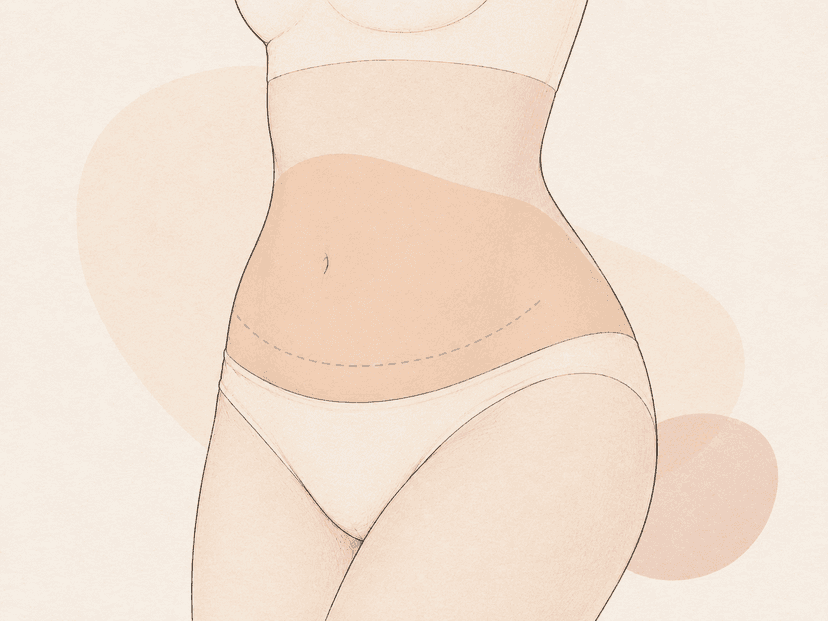 Abdominoplasty